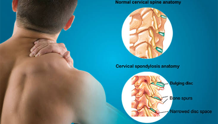 Cervical Spondylosis